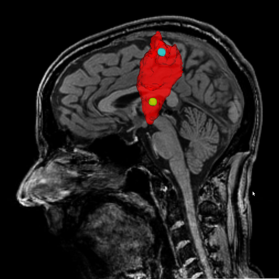 Diffusion MRI: Brain Connectivity Mapping