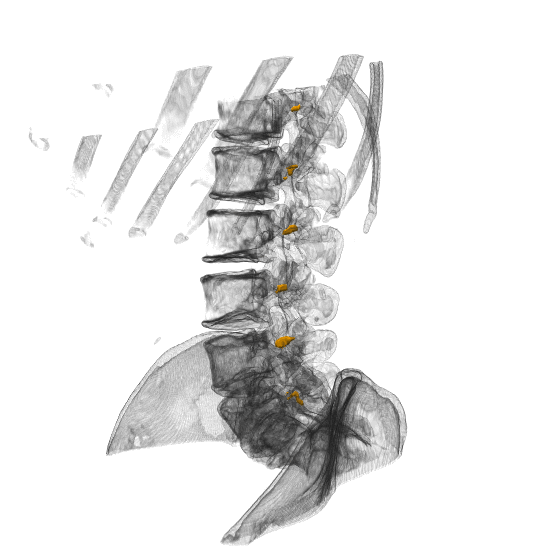 Spine Segmentation